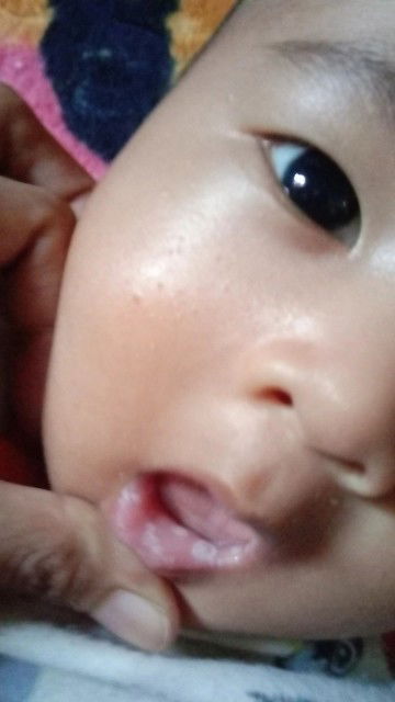 Bibir bayi