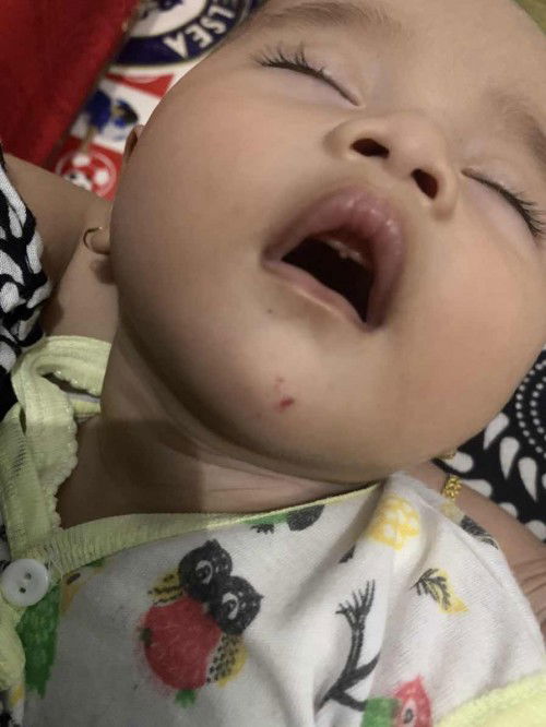 Timbul merah di dagu