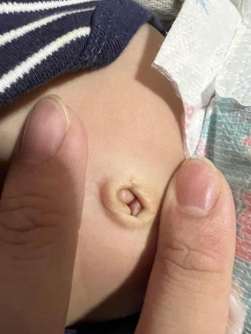 ขอคำแนะนำ สะดือไม่แห้ง