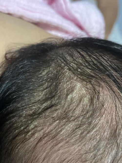 Đầu bé bị cứt trâu