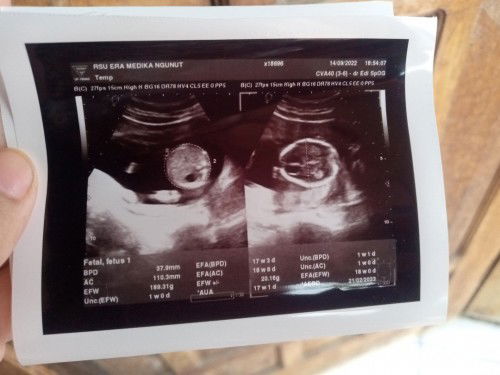 Cara baca panjang janin dari hasil USG