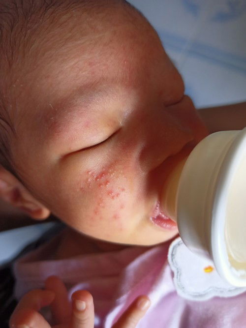 ผื่นเเดงเด็ก