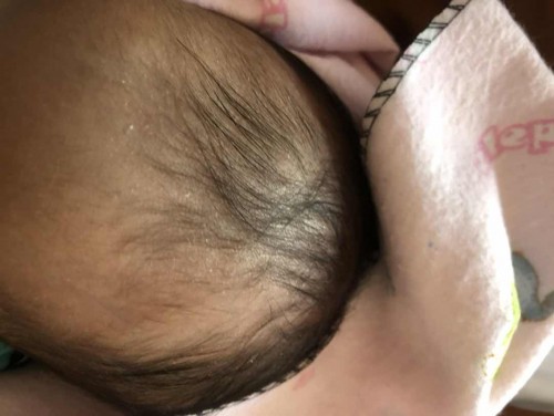 Rambut bayi rontok
