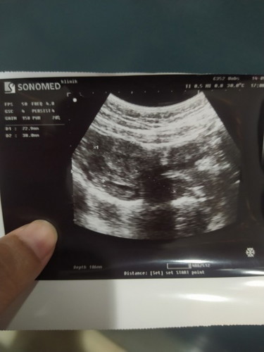 Tanya hasil USG bun