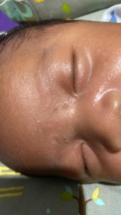 Bruntusan seperti panu pada bayi