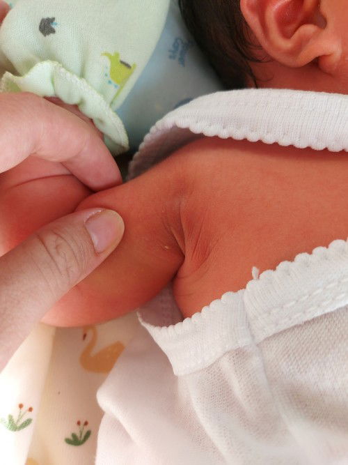 Ijin tanya bun, bentol ada nanahnya kenapa