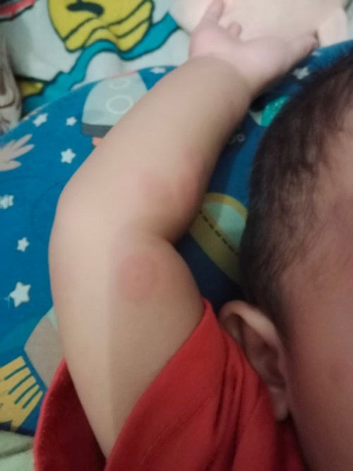 Bercak Merah pada bayi