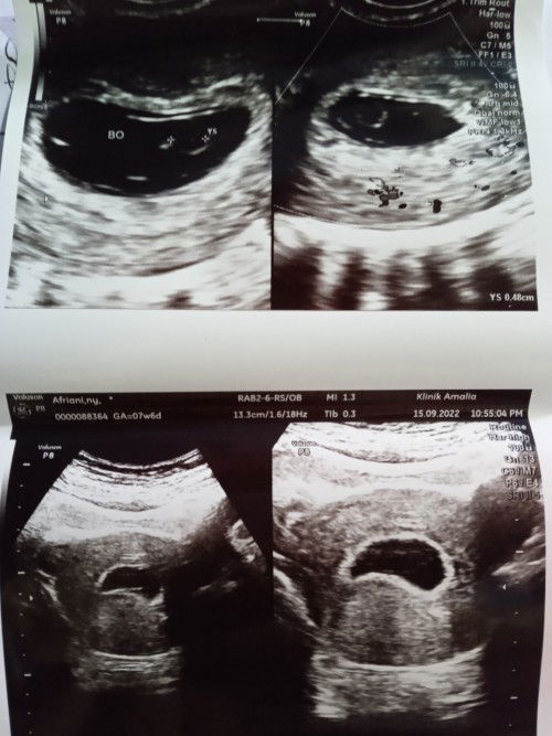 BO untuk kedua kalinya