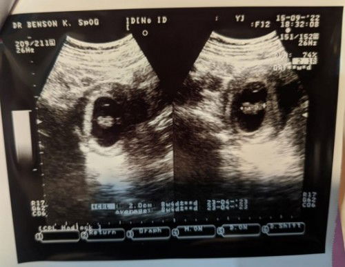 Tanya tentang usg bun