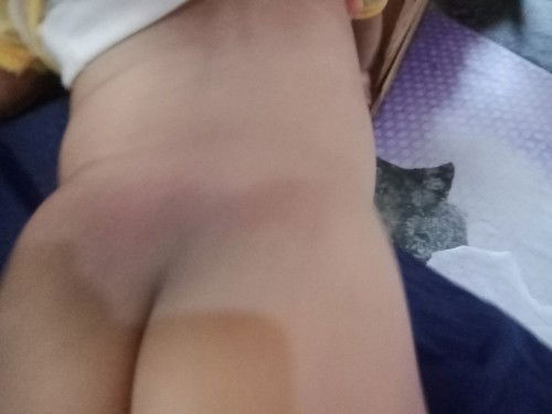 Merah-merah pada pantat bayi