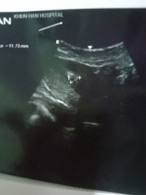 เมื่อวาน15/9ไปซาวด์ดูน้องมาไม่เห็นถุงอะไรเลยค่ะแม่ๆ ปจด มาครั้งล่าสุด4 /8 พยาบาลนับได้ว่า 6วีค