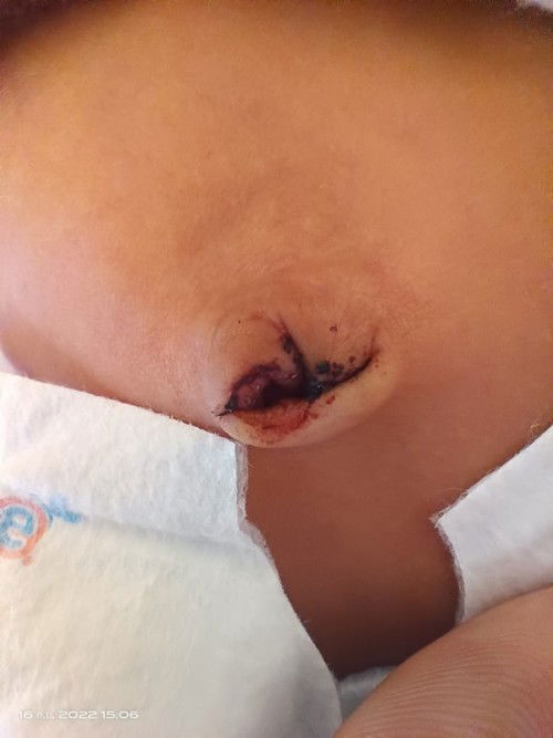 สะดือหลุดมีเลือด