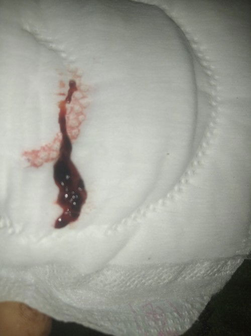 Ass.. bunda.mau tanya...apa ini berupa jaringan janin yg keguguran y bund,,😭