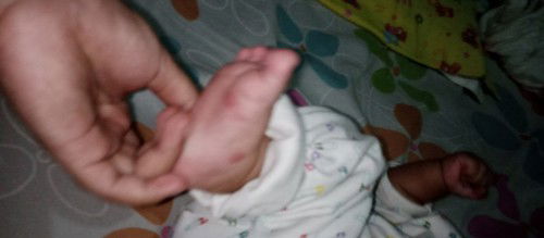 Merah gigit nyamuk kah? Bayi 3 bulan