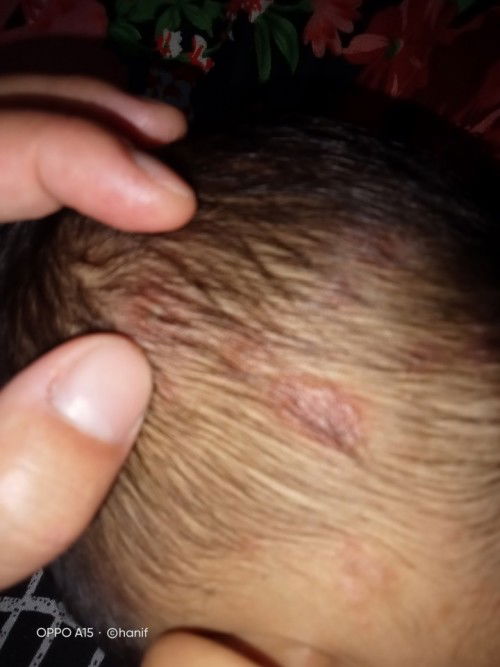 Bun,mau nanya dong barang kali ada yg pernah anak nya sakit seperti ini,ini bisul ato bukan ya??