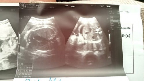 น้องมีน้ำในช่องท้อง