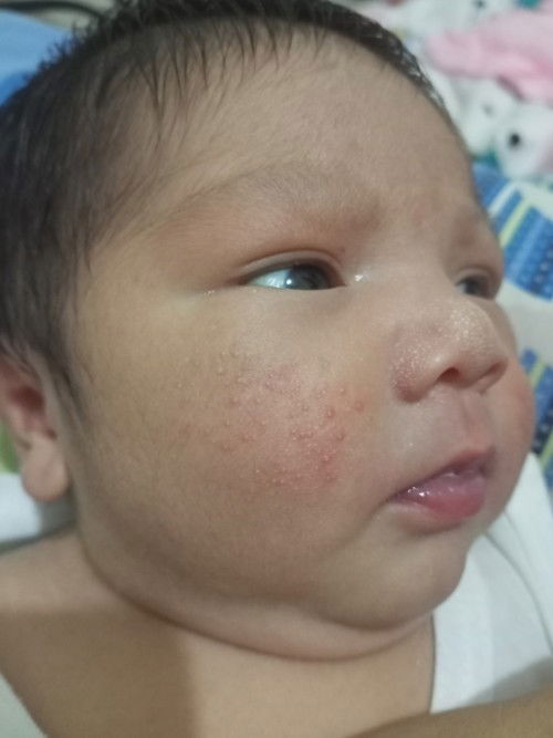 Normal po ba itong parang tagihawat sa face ni baby? Ano po pwede gawin?