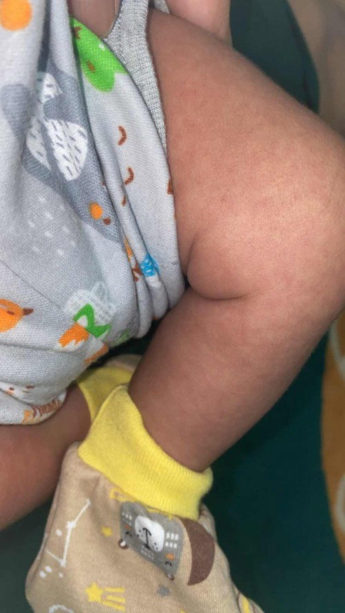 Badan bayi bercak merah