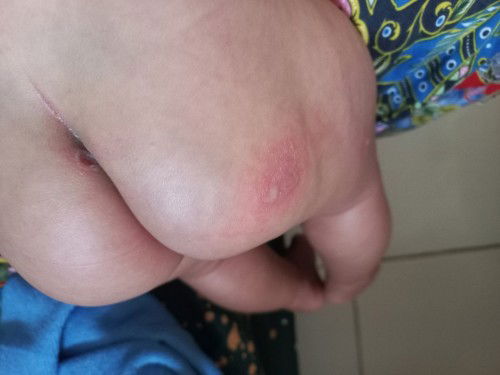 Borok pada bayi 2 bulan