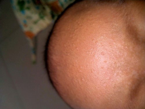 Bintik bintik dan bercak putih pada dahi bayi