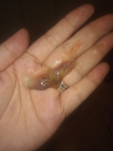 Mucus plug