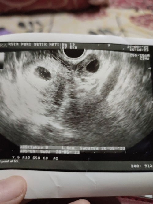 USG bayi kembar