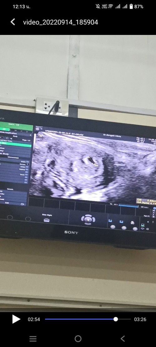 เคยแท้งท้องแรกค่ะ