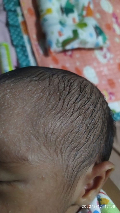 Biang keringat dikepala bayi