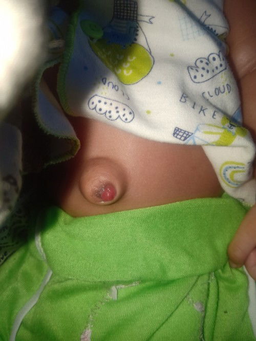Pusar bayi usia 1 bulan 23 hari