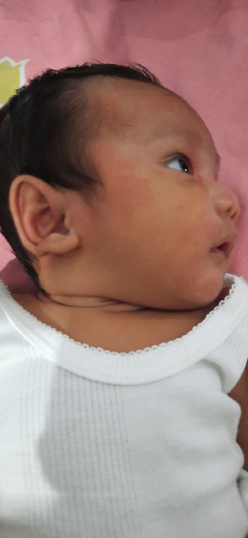 Pruntusan/jerawat Bayi