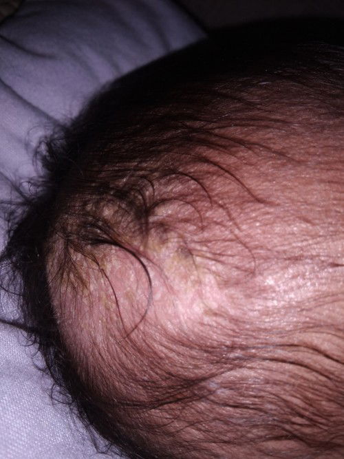 cradle cap si bayi