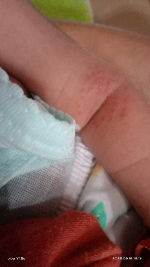 Gatal gatal pada kulit bayi