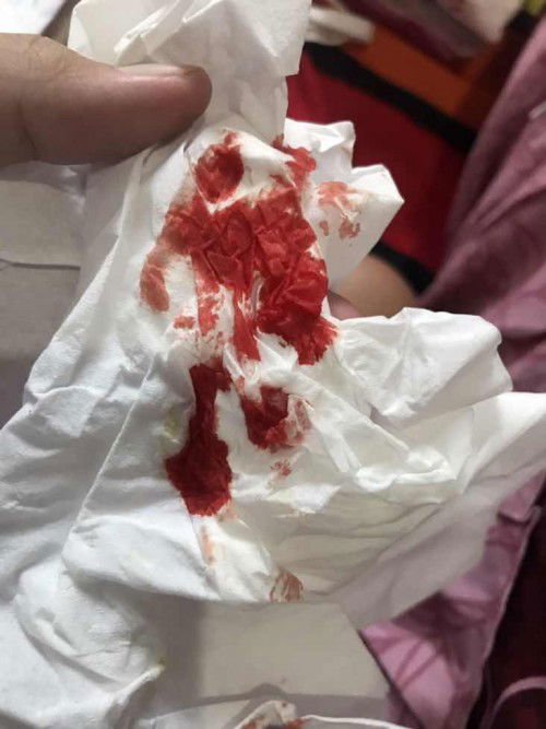 Mimisan kehamilan 32w