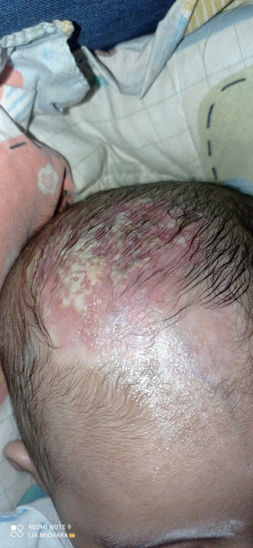 Kepala bayi umur 3 bulan terkena jamur sampai bernanah