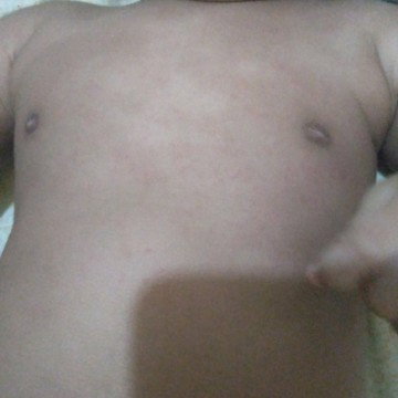 Bintik merah pada bayi