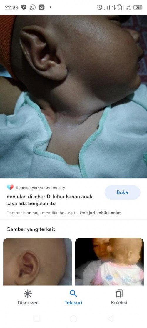 Assalamu'alaikum bunda ada yg tahu penyebab serta obat untuk benjolan bayi seperti digambar? Mksih