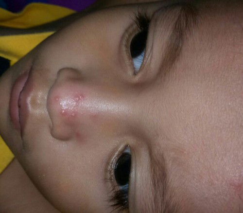 Bintik seperti jerawat