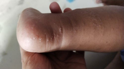 Bentol kecil dan berair