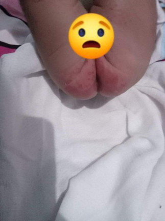 Gmot sa rashes