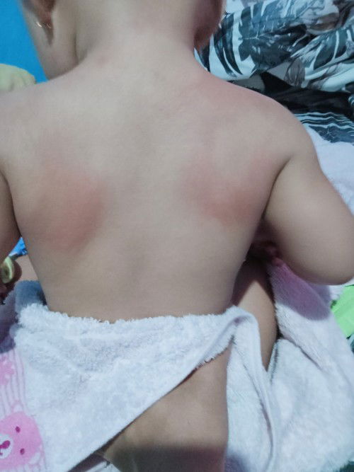 kenapa ya pake lactacyd baby malah merah kering