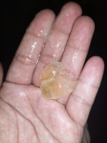 Mucus plug