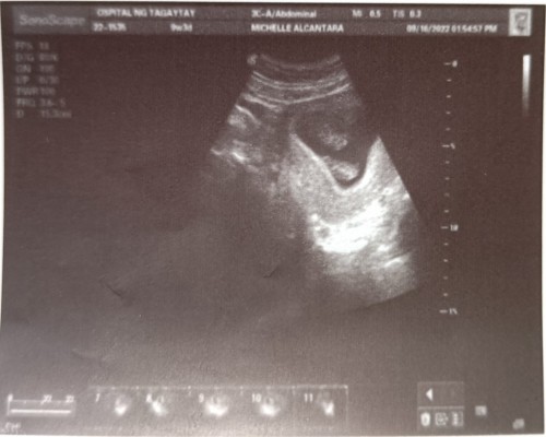 Having Twins.
