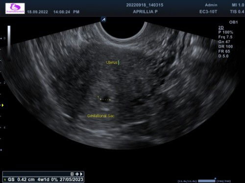 Usia kehamilan 4 minggu