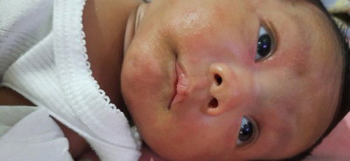 Jerawat /pruntusan pada bayi