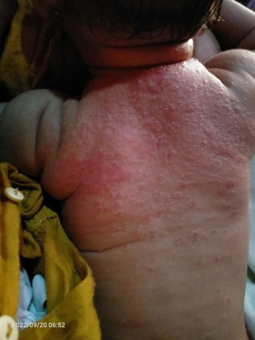 Kemerahan pada punggung