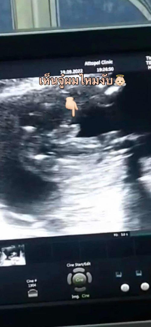 ตอนท้องมีแต่คนทักว่าได้ลูกสาวแน่เลย🥹