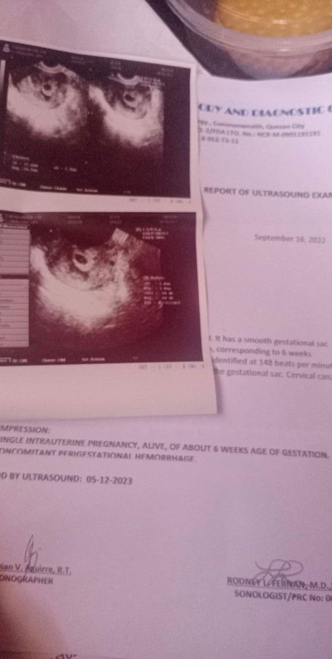Perigestional Hemorrhage