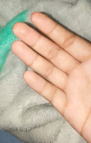 แม่ๆค่ะตอนนี้39w.แล้วมีน้ำแบบนี้ไหลออกมาแตาไม่เยอะเหมือนวุ้นแต่เหนียวคือเป้นตกขาวหรือใกล้จะคลอด