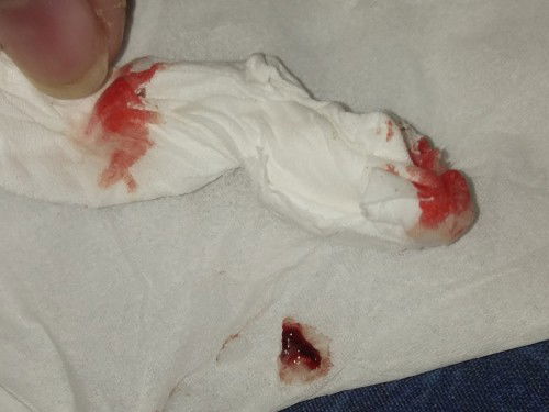 เลือดซึมที่โพรงจมูก