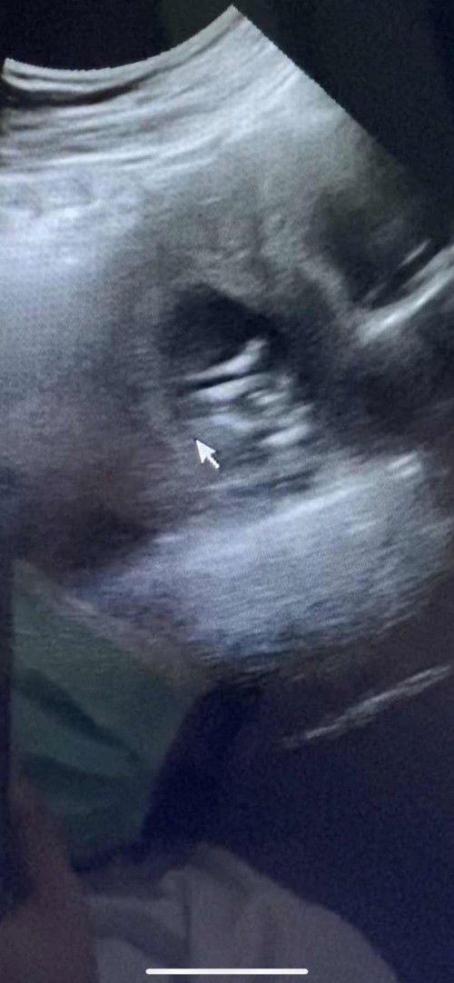 วันนี้ไปพบลุงหมอมา 14w3d ตัวเล็กนอนอ้าซ่าโชว์ลุงหมอ พี่ๆเพื่อนๆว่า ญหรือช ค่ะ 😍❤️